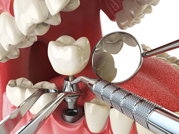 Best Emergency Root Canal Therapy in Dallas, OR